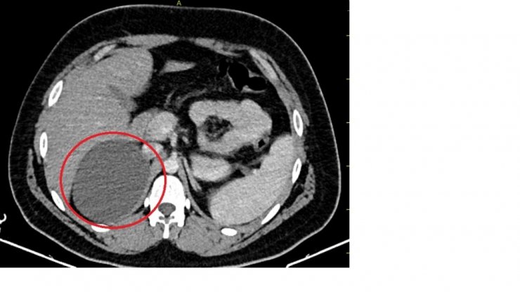 Laparoskopik yöntemle böbreküstü bezinden 11 santimetrelik kitle çıkartıldı