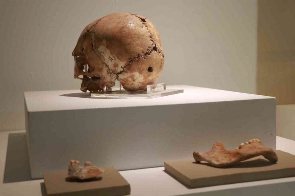 Dünyanın ilk beyin ameliyatı Aksaray’da gerçekleşmiş